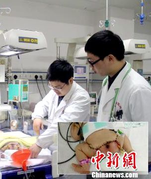 江西一16斤巨婴出生两天后被切除9斤胎瘤