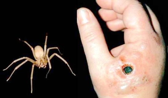 被红头平甲蛛叮咬具有很大的潜在危险。